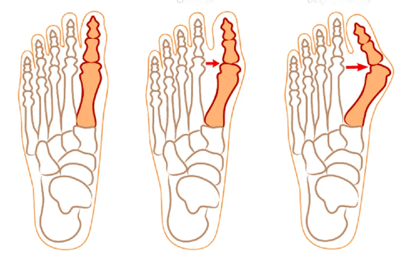 Hallux valgus deformity