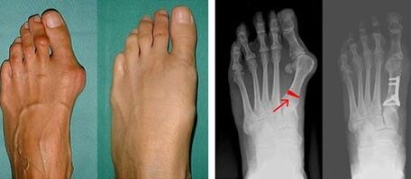 Symptoms of hallux valgus