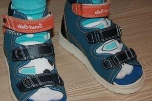 Wearing sandals for hallux valgus in a child