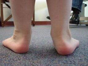 Flat valgus foot deformity in a child