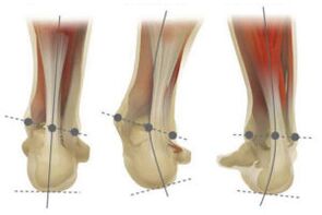 Normal foot with valgus and varus deviation of the heel bone