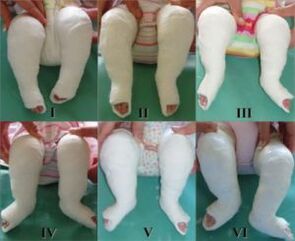 Plaster procedures, each of which changes the position of the foot