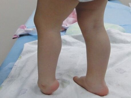 The first symptoms of the valgus deformation of the foot
