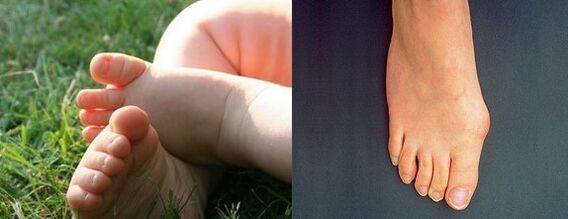 Valgus deformation of the first foot finger