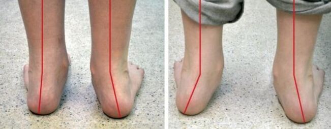 Valgus foot