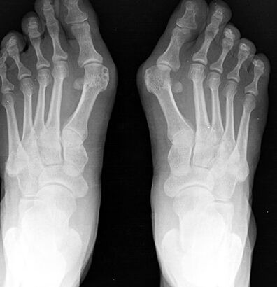X -beam of the foot