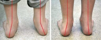 Valgus curvature